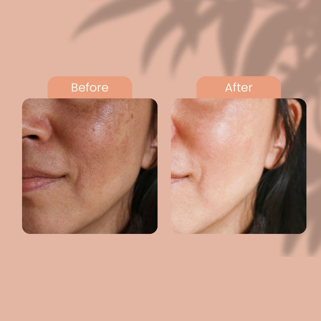 Korean Skincare Melasma